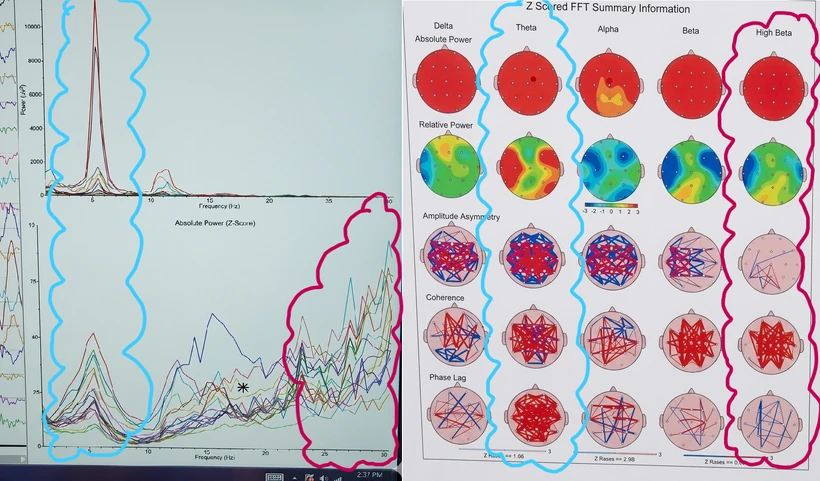 Annotated qEEG State B power frequency distribution