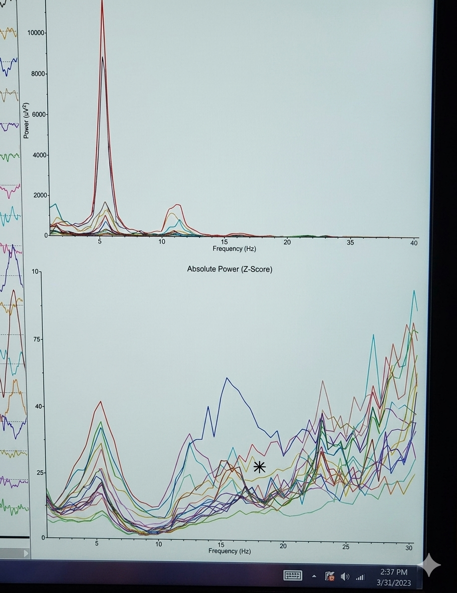 Meditative State B — z-score and frequency band graph showing anomalous readings