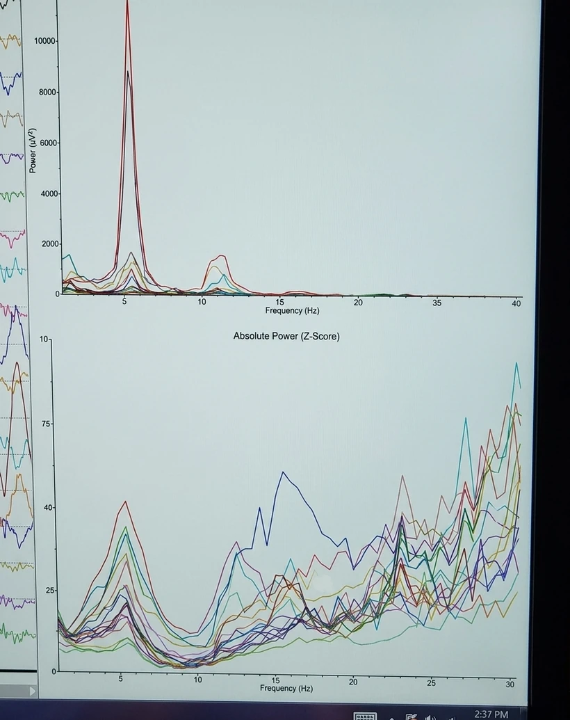 Meditative State B — z-score and frequency band graph showing anomalous readings