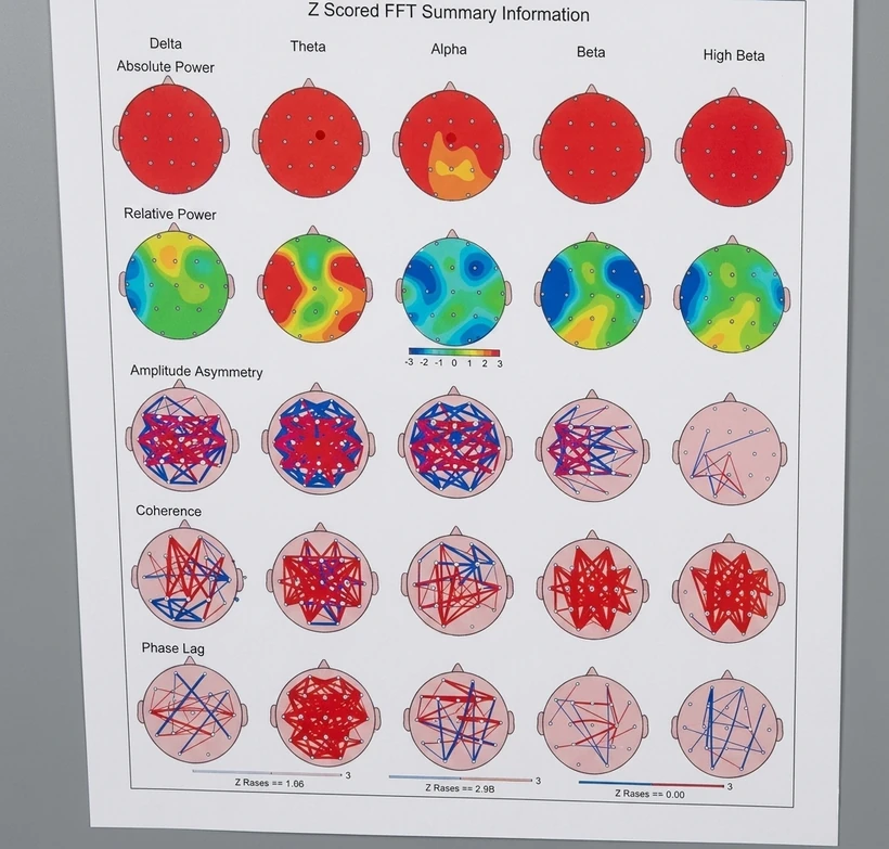 Meditative State B — topographic head map showing 700+ microvolt distribution